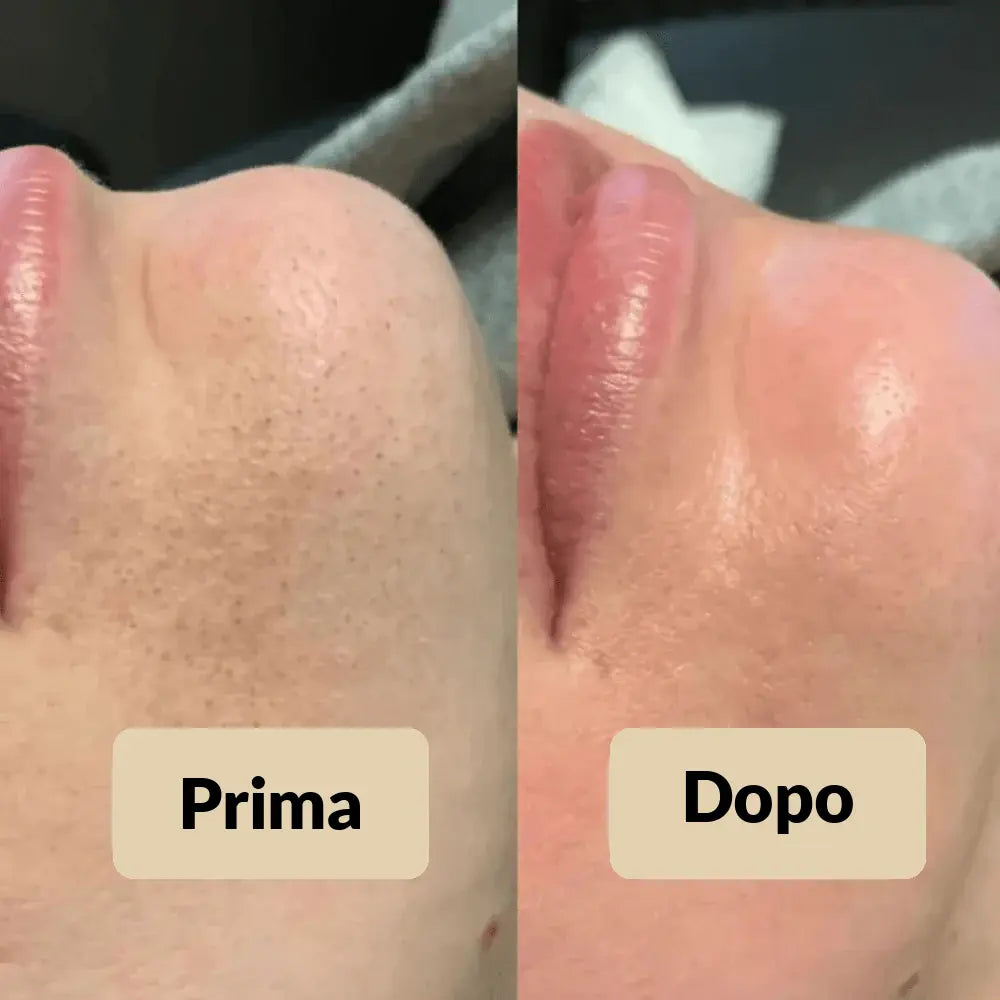 Peel Shot Elimina le impurità - Glynea™