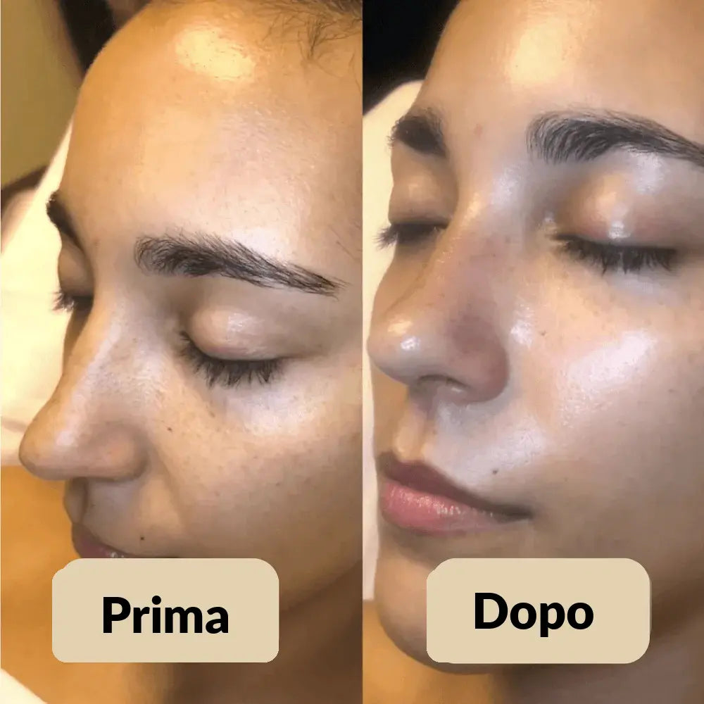 Peel Shot Elimina le impurità - Glynea™