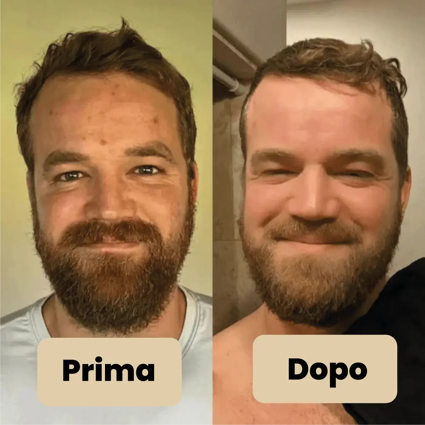Peel Shot Elimina le impurità - Glynea™